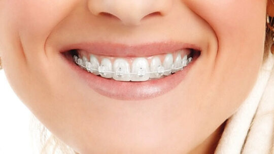 зуби з брекетами