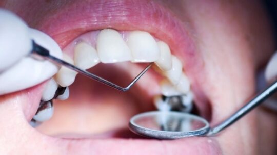 лікування карієсу