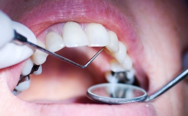 лікування карієсу